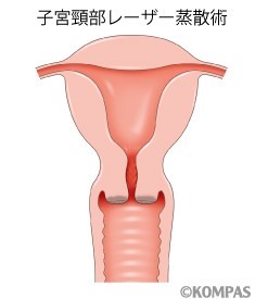 子宮頸部異形成に対するレーザー治療
