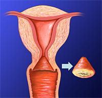 子宮頸部円錐切除術
